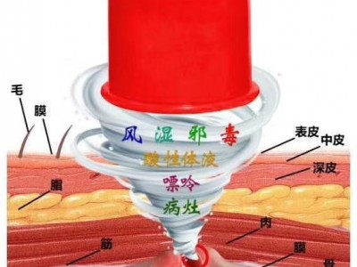 川坤拔罐组合套盒多少钱 川坤拔罐原理