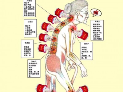 萨满拔罐液团购价格  萨满48穴都要拔吗