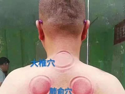 川坤拔罐能治腰椎间盘突出吗