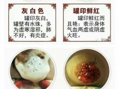 川坤拔罐痛风患者拔了有作用吗