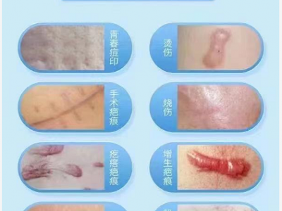 青岛中腾生物星疤克