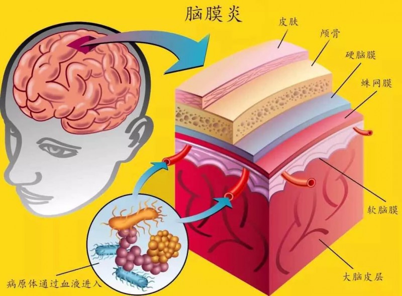 【详解】成人脑膜炎的早期症状有哪些