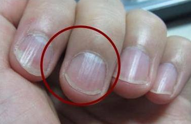 大拇指指甲上有竖纹怎么回事 6种因素导致指甲上有竖纹