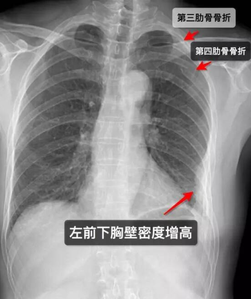 肋骨骨折后注意事项 四大注意事项至关重要