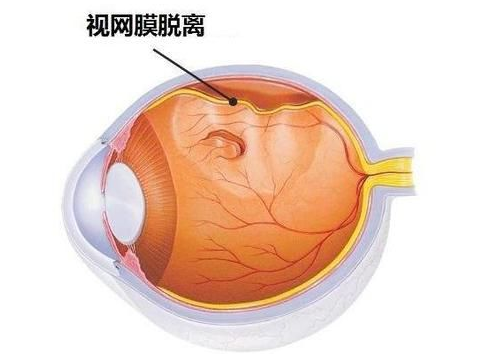 视网膜脱落原因 【图】引起视网膜脱落的四大“元凶”