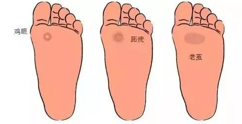 鸡眼是怎么形成的 注意三点让你看清鸡眼的演变