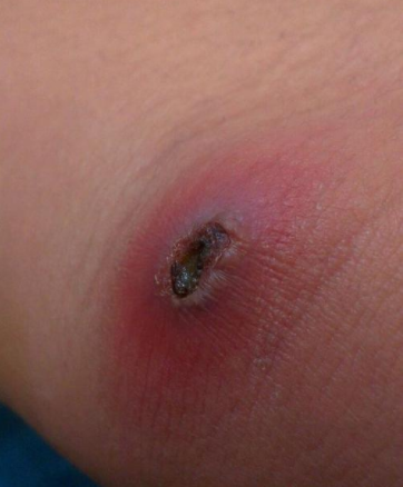 起疖子怎么办 【盘点】起疖子的三种治疗方法