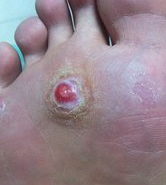 脚鸡眼是怎么形成的 教你准确区分鸡眼和跖疣