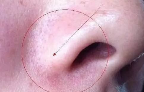 鼻子下面红血丝应该怎么办 三大治疗鼻子血丝的方式