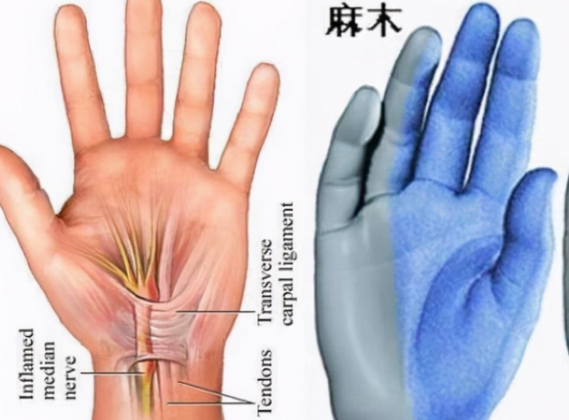 睡觉手麻是怎么回事 揭秘睡觉手麻的两大因素