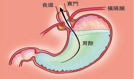 胃酸过多吃什么 三类食物中和胃酸效果好