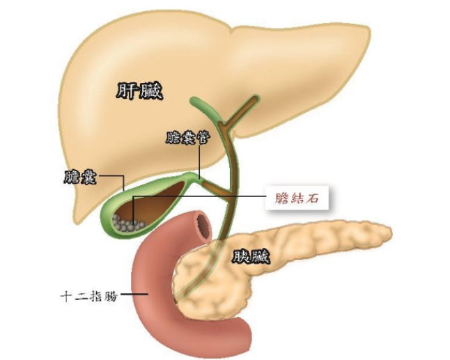 胆结石怎么形成的 详解胆结石形成的原因