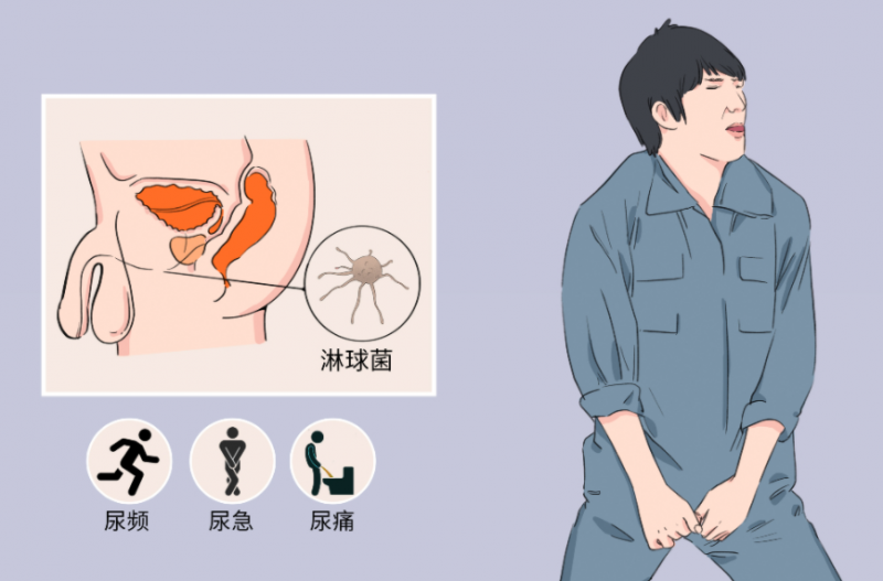 男性尿道炎吃什么药治疗 中医推荐利尿消炎药丸