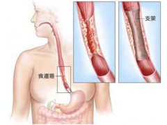 怎么治疗食道癌 中医治疗食道癌的三大处方