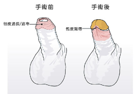 包皮长度多少算正常 首先了解什么是包皮过长