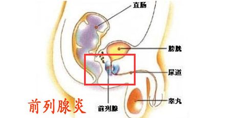 解答前列腺炎会射精痛吗 如何预防前列腺炎的出现