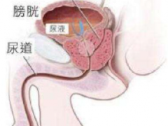 如何保护前列腺 三食方提高男性生活质量