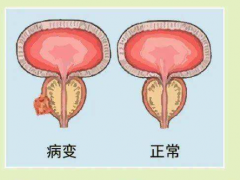 前列腺炎怎么治疗 治疗前列腺炎的秘方