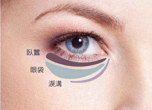 眼袋重怎么办