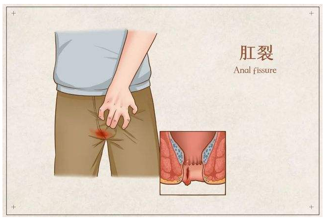 怎么会引起肛裂 肛裂怎么治疗最好