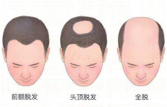 植发后还会脱发吗