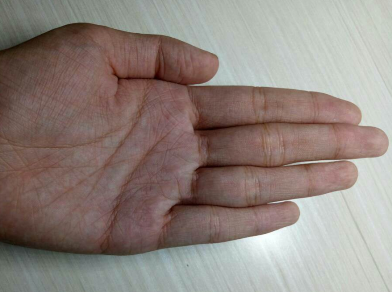 手上皱纹多怎么去除