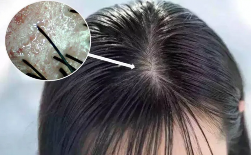 如何治疗女性脂溢性脱发 无痕植发最常见