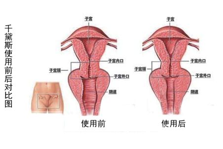 阴道松弛问题是随着女性年龄增长而出现的一种生理现象,所以每一个