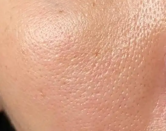 毛孔粗大究竟是什么原因
