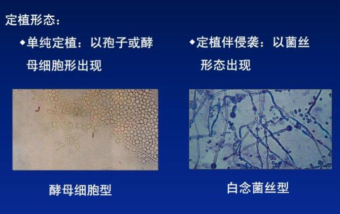下面瘙痒还有豆腐渣一样的分泌物，外阴瘙痒白带豆腐渣如何用药