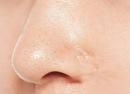 如何修复面部毛孔粗大