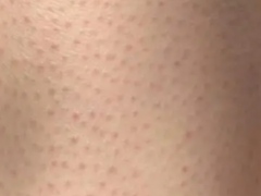 攻克鸡皮肤：腿上有鸡皮肤怎么消除？告别腿上一粒一粒像鸡皮肤的烦恼！