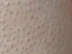 祛除腿上一粒一粒像鸡皮肤攻略之维A酸乳膏+尿素霜真的可以去鸡皮肤吗？