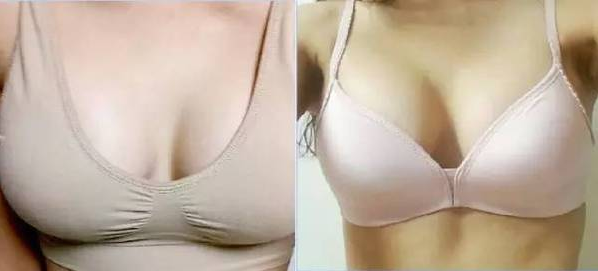 女人什么时候最想要隆胸（假体隆胸女性的年龄一般是多少岁）