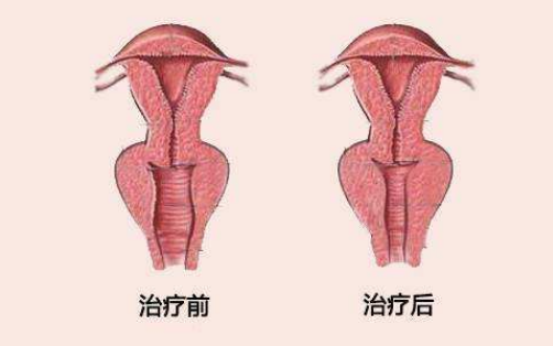 产后阴道松弛怎么办（如何锻炼阴道使其更紧）