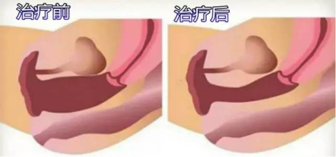 产后阴道松弛如何恢复（5种运动让你的阴道更紧致）