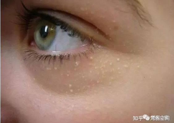 女性保养脖子上长脂肪粒是什么原因（如何去除颈部脂肪粒）