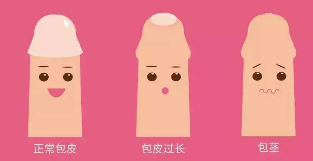 包茎过长该如何判断（揭秘判断包茎过长的五个小方法）