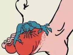 脚的大拇指疼是怎么回事 要如何解决
