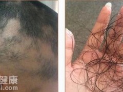 男的掉头发是什么原因  揭秘脱发的三大诱因
