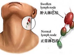 淋巴瘤患者的饮食原则 单糖人参皂苷rh2很不错