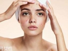 痘痘反复长是什么原因？基础护肤不够用心