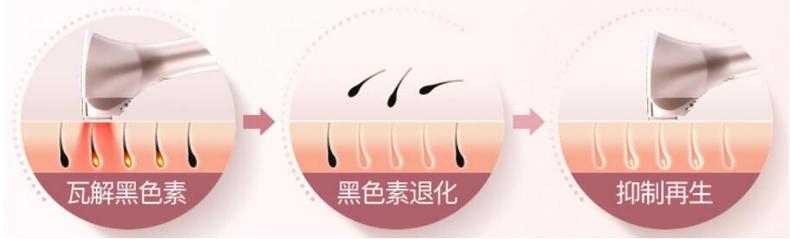 彩光脱毛安全吗 彩光脱毛能永久脱毛吗 彩光脱毛安全吗 彩光脱毛能永久脱毛吗