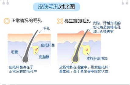 脸上长痘痘怎么快速去除 如何一天之内消除痘痘 脸上长痘痘怎么快速去除 如何一天之内消除痘痘