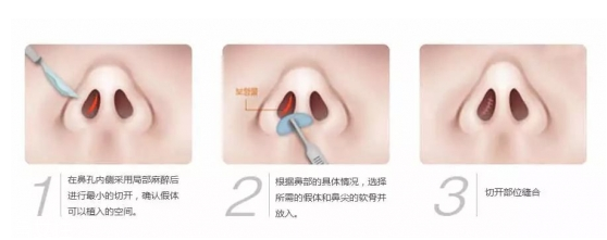 鼻子整形有几种方法 鼻子整形哪种方法最好