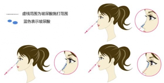 鼻子整形有几种方法 鼻子整形哪种方法最好