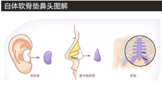鼻子整形有几种方法 鼻子整形哪种方法最好