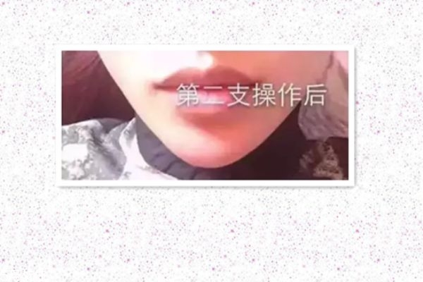 玻尿酸打下巴怎么打的 玻尿酸打下巴是什么感觉