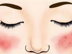 红血丝怎么消除 红血丝消除小偏方