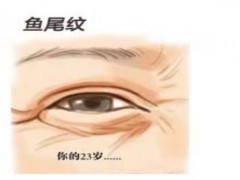 为什么会长鱼尾纹呢 怎么样可以消除鱼尾纹呢